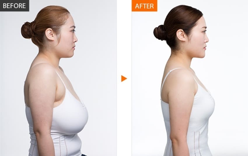 Photo avant et après une réduction de seins