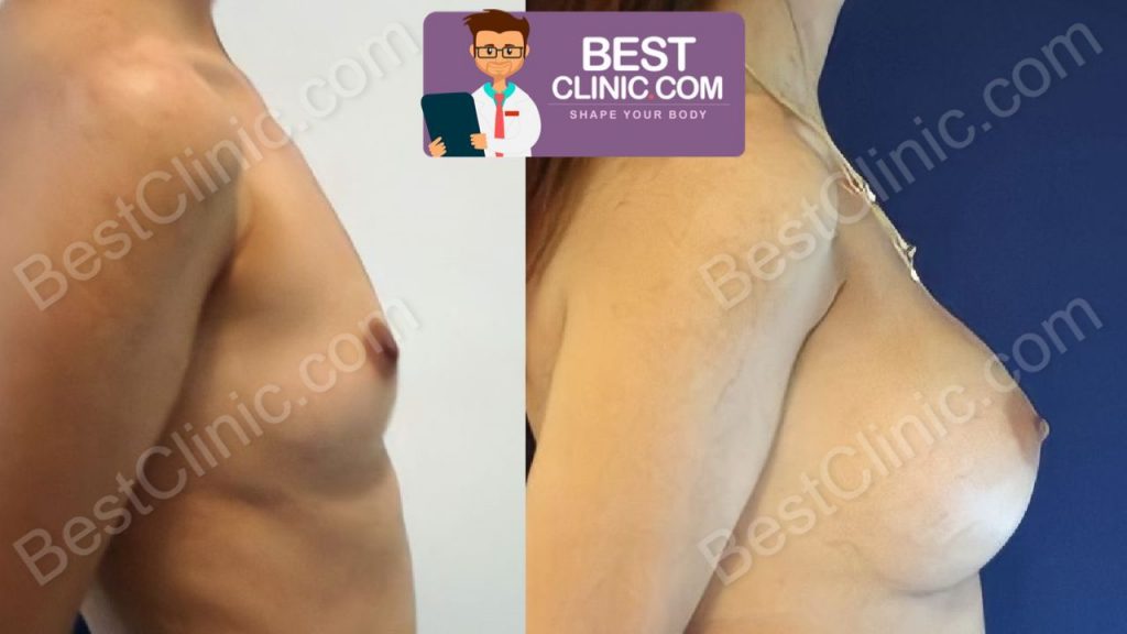 augmentation mammaire turquie : photos avant après