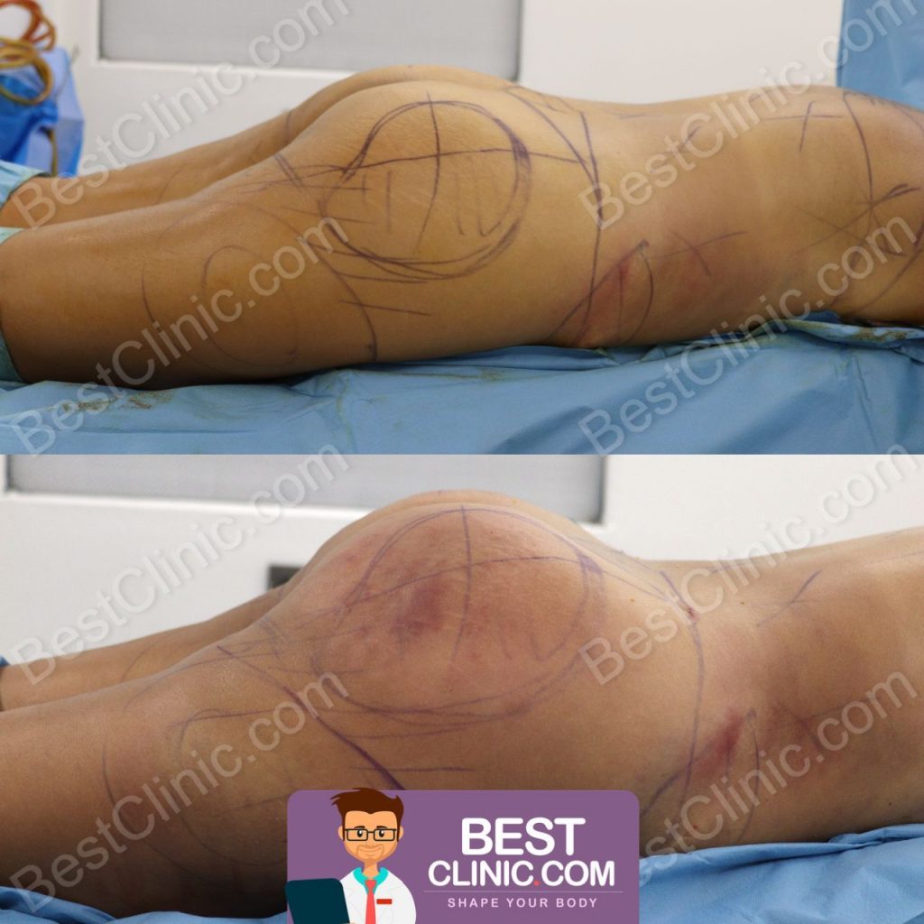 BBL turquie photos avant apres